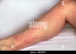 Image result for allergy rash on the legs
