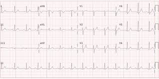 Journal of the american college of cardiology vol. View Of Clozapine Associated Myocarditis Case Report And Literature Review Canadian Journal Of Hospital Pharmacy