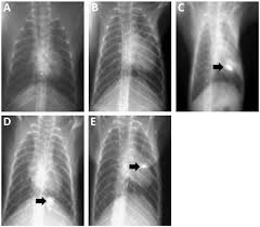 We removed the branch that was five centimeters long, the surgeon said. Chest X Rays Showing Changes In The Lungs Of Tree Shrews A Eleventh Download Scientific Diagram