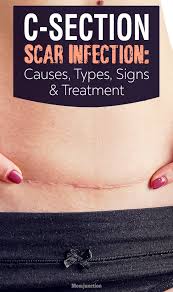 C Section Scar Yeast Infection Cost Xksr Lavanda Galery Ru