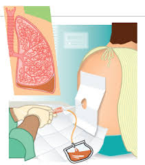 Image result for Thoracentesis