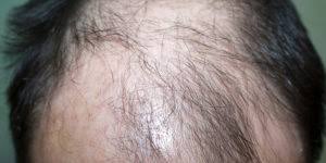 In all cases, it is always prudent to visit your medical professional for treatment advice. How To Remove Excess Sebum From Scalp Causes And Tips