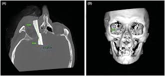 Minimally invasive keyhole supraorbital craniotomy as treatment option for  penetrating foreign body through orbital roof