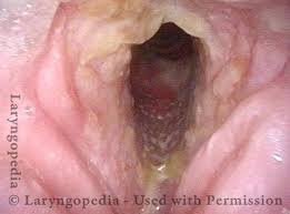 Image result for Chronic Laryngitis