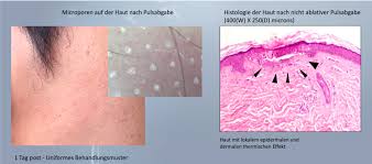 Fahren sie bitte mit der maus auf das gewünschte foto, damit sie das nachher ergebnis sehen können! Informationen Zum Behandlungsablauf Rpm Medical Kosmetik Rafael Peter Mischewski Monchengladbach
