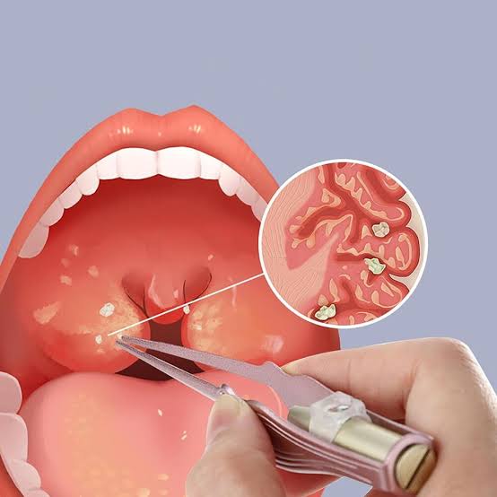 Sỏi amidan là gì? Nguyên nhân, triệu chứng, cách trị - Tập đoàn y khoa Hoàn  Mỹ