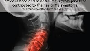 In this article, we'll go over causes, types of ms, symptoms, medications, and more. Can That Whiplash From Years Ago Be The Cause Of Your Multiple Sclerosis Symptoms Chiropractor Wall Nj
