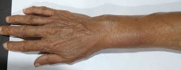 Patients often have swelling and grinding with finger movement. Intersection Syndrome Radiology Case Radiopaedia Org