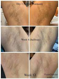 I am a licensed electrologist, and although it is said that the only permanent method of hair removal is electrolysis, it is a more tedious procedure, and for me painful. At Home Ipl Laser Hair Removal Handset Roseskinco