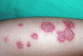 Image result for Eczema nummulare