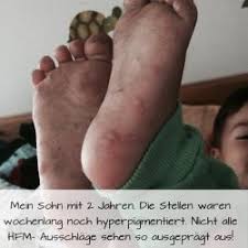 Hallo, im kindergarten meines sohnes ist vermehrt hand mund fuß krankheit aufgetreten. Die Hand Fuss Mund Krankheit Eine Qual Fur Kinder Und Erwachsene Dr Mami