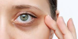 Dark Circles Treatment in Dubai - Get Youthful Glow