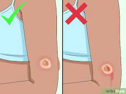How To Get Rid Of A Scab: 9 Steps (With Pictures) - Wikihow