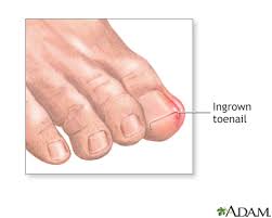 Only a qualified professional should undertake this task. Disease Ingrown Toenail