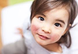 Lanarkshire aesthetics glasgow, special introductory offer treatment injections. When Your Child S Chapped Cheeks May Actually Be A Common Childhood Infection Health Essentials From Cleveland Clinic