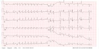 Image result for Extrasystole