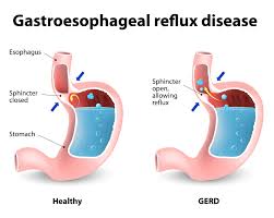 Pin On Reflux Sucks