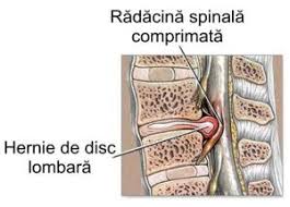 Inainte de operatie aveam aproape toata laba piciorului stang amortita. Tratament Pentru Hernie De Disc FÄƒrÄƒ OperaÈ›ie Centrul Litherapy