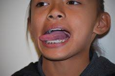 52 Tongue thrust ideas