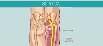 Is it possible to damage your stomach the only organs in the traditional thought that are on the right side of the back and isn't underneath the ribs is the right kidney (lower back next to the. What Causes Sciatica Natural Healthcare Center