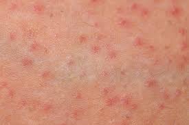 Foliculita Cauze Simptome Tratament Si Preventie