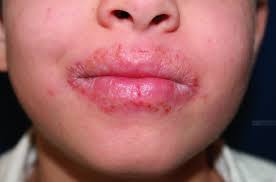 Image result for dermatitis contacta children
