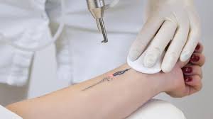 Before you undergo the procedure, make sure to keep in mind these 6 side effects you'll likely. Laser Tattoo Removal Fungsi Prosedur Dan Komplikasi