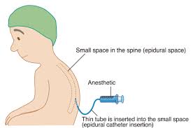 Image result for Intrapleural Anesthesia