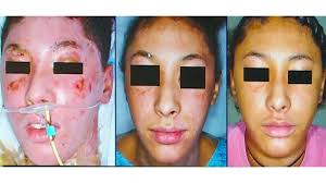 New procedure tested in New Orleans is changing lives for burn victims