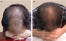 Reviews her concerns in this video, and explains how microneedling can cause hair shedding, and why injection treatments are generally better for hair loss: Microneedling In Androgenetic Alopecia Comparing Two Different Depths Of Microneedles Faghihi 2021 Journal Of Cosmetic Dermatology Wiley Online Library