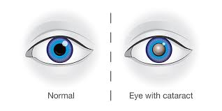 Next, we remove the damaged lens. Cataract Aoa