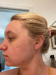 Ever check out the results to our 8 Week Acne Scar Remediation Oil Clinical  Trial? Here it is! Get with your Pomifera partner if you have questions or  wonder if this may