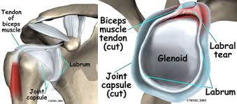 We've got the acromion posteriorly and the coracoid process anteriorly. Labrum Repair Samimi Orthopaedic Group West Covina West La Ca