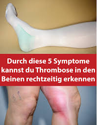 Thrombosen können in venen ( venenthrombose ) oder in arterien ( arterielle thrombose ) auftreten. Durch Diese 5 Symptome Kannst Du Thrombose In Den Beinen Rechtzeitig Erkennen Thrombosis Legs Health