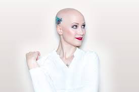 Alopecia is hair loss or balding. Tattooing Or Permanent Make Up Alopecia Areata
