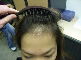 Nei pazienti con alopecia areata del cuoio capelluto, durante la fase di . Panico Stempiatura Femminile Cause Rimedi E Modi Per Camuffarla