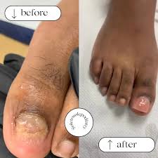 Image result for Toenail Removal