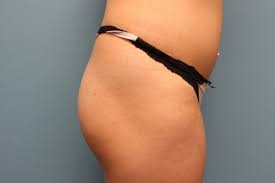 Check spelling or type a new query. Brazilian Butt Lift 4260 Vernon Hills Chicago Il Ritacca Cosmetic Surgery Medspa