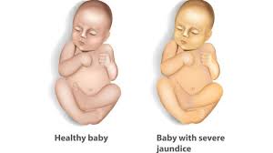 Jaundice: Causes, Symptoms, and ...