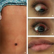 Sars Cov 2 Infection Triggering Recurrence Of Kawasaki Disease In A 10 Year Old Child Bmj Case Reports