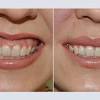 + how does gum contouring work ? 1