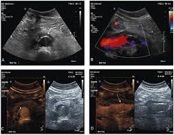 Delaware, georgia, minnesota and utah. Contrast Enhanced Ultrasound Of The Abdominal Aorta Current Status And Future Perspectives Vasa
