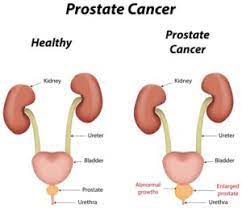 Its associated mortality accounts for approximately 3.8% of all cancer deaths in men (bray et al., 2018). Prostate Cancer International Medical Treatment Ltd