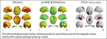 흑색질은 뇌간 내 깊은 층에 위치하며 몸의 움직임을 부드럽게 하는 데 도움을 줍니다. ë„ë„¤íŽ˜ì§ˆì´ íŒŒí‚¨ìŠ¨ë³' ê²½ë„ì¸ì§€ìž¥ì•  í™˜ìž ë‡Œê¸°ëŠ¥ í˜¸ì „ì— ì˜í–¥ ë„¤ì´íŠ¸ ë‰´ìŠ¤