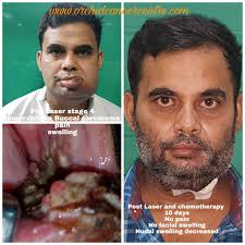 These cancers usually occur in the thin, flat cells called squamous cells that line the buccal mucosa and other parts of the mouth. Ayurvedic Ayurveda Treatment For Oral Mouth Tongue Cancer In Mumbai