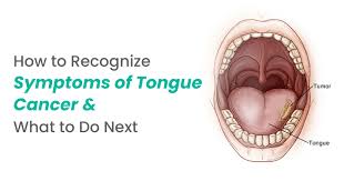 Image result for cancer tongue symptoms)
