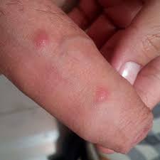 Granos Rojos Que Me Pican En Escroto Y Pene Dermatologo Net