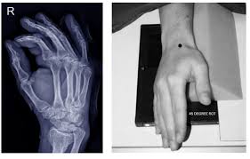 Image result for Hand XRay