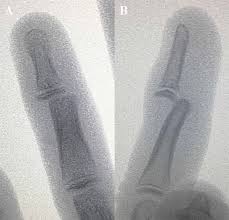 Image result for Interphalangeal Dislocation