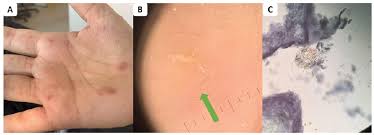 The Management Of Scabies In The 21st Century Past Advances And Potentials Html Acta Dermato Venereologica